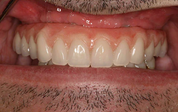 After — secure, stable fixed arch mouth restoration completed at D'Arcy Dental in Okotoks
