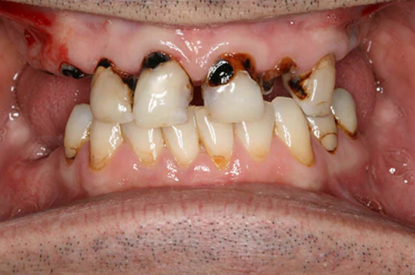 Before — failing dentition and unstable bite prior to fixed arch mouth restoration at D'Arcy Dental