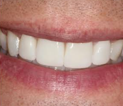 After — digitally designed custom smile with snap-on implant dentures at D'Arcy Dental