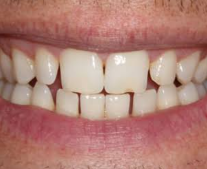 Before — worn, cracked and discoloured teeth before implant-supported restoration at D'Arcy Dental