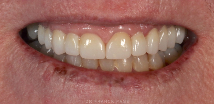 After — complete natural-looking smile restored with full-arch dental implants at D'Arcy Dental in Okotoks