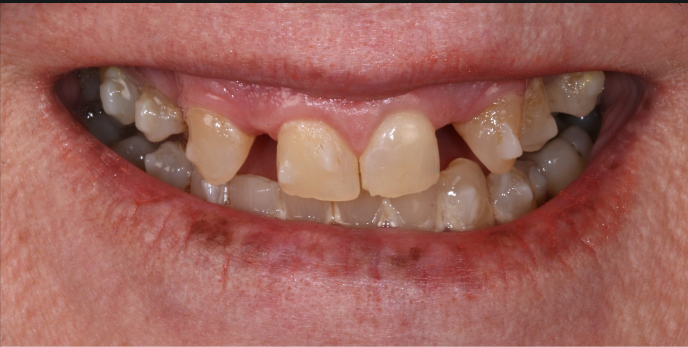 Before — missing and damaged front teeth prior to full-arch dental implant treatment at D'Arcy Dental in Okotoks